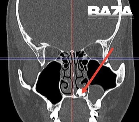 Житель Подмосковья несколько лет жил с молочным зубом в носу