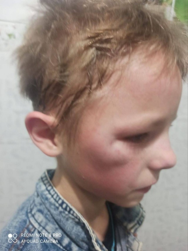 В ХМАО 12-летнего мальчика избили до сотрясения мозга и провалов в памяти из-за сдачи с покупки хлеба