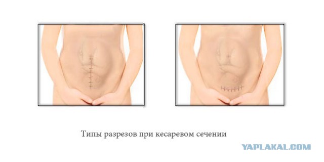Наглядный пример для девушек, которым делали кесарево