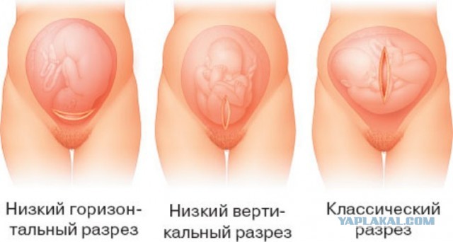 В омском роддоме №1 врачи изуродовали молодую роженицу