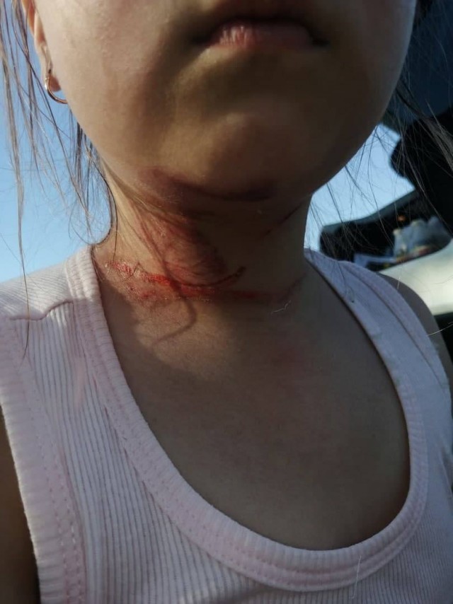 В Омской области шестилетняя девочка едва не лишилась головы из-за натянутой верёвки