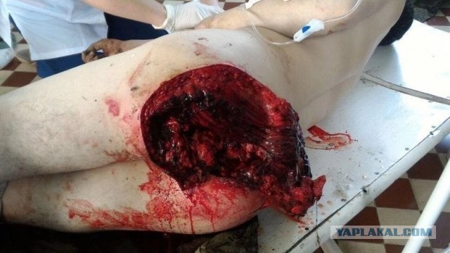 Американец вставил себе в задницу ракету-фейеверк, но она дала осечку