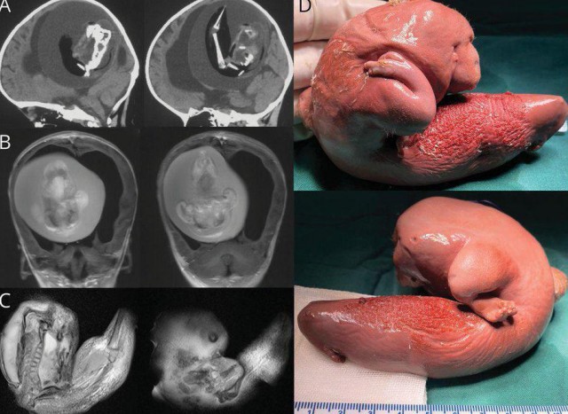 Чужой. Удалено из головы маленький девочки