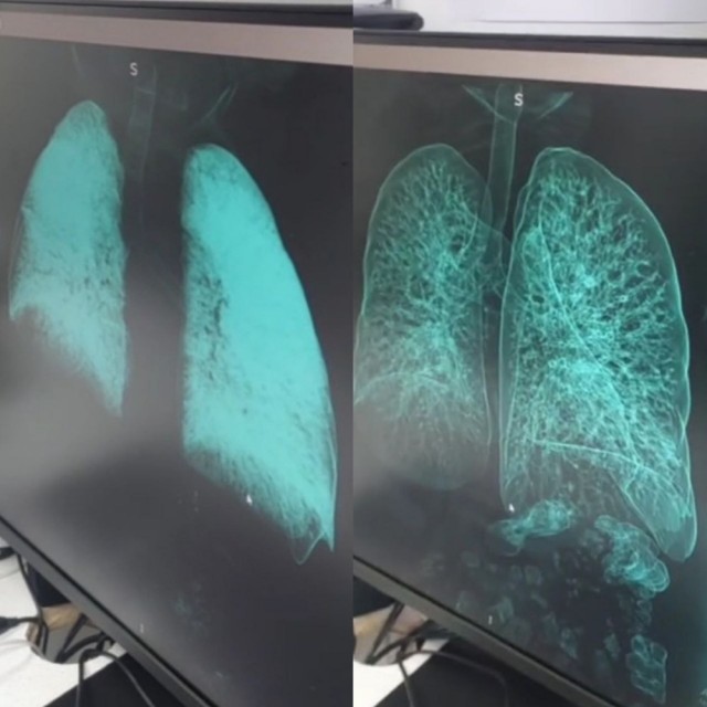 Врачи показали лёгкие одного из бойцов, участвовавших в операции «Поток» в Курской области