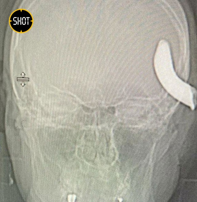 Металлический крюк из черепа мужчины достали питерские врачи и спасли ему жизнь. Операция длилась три часа.