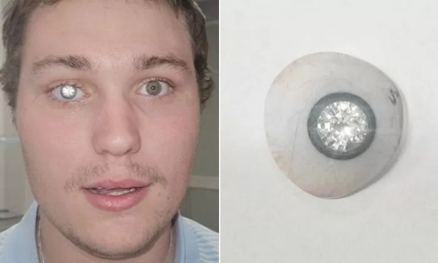 Американец вживил в свой искусственный глаз бриллиант весом в 2 карата