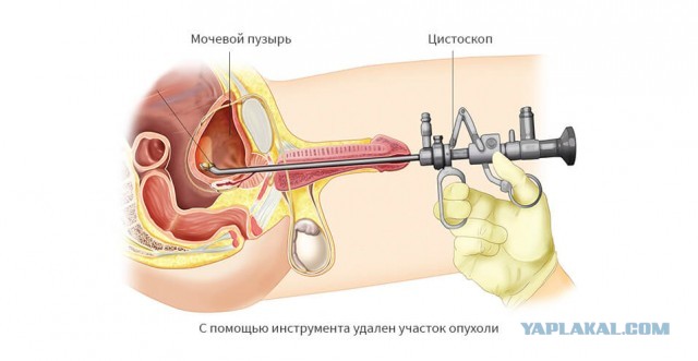 Гастро- или колоноскопия — что лучше?