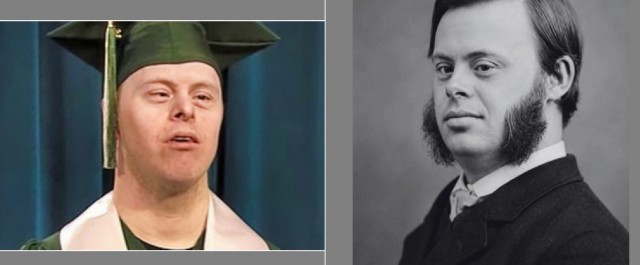 Несправедливо забытая история доктора Дауна, который впервые описал известный синдром.