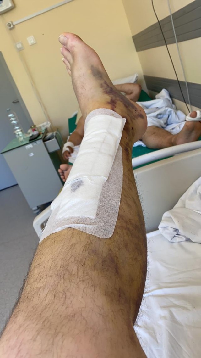 Продолжение истории про перелом
