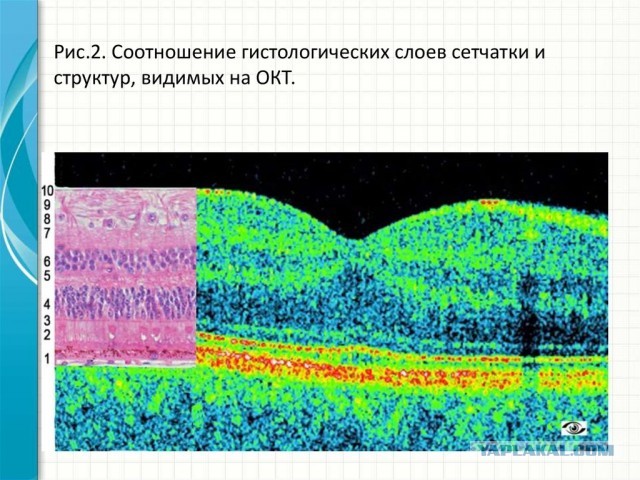 Что ищут офтальмологи у пациентов с отслойкой сетчатки?