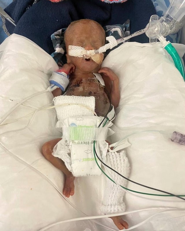 Самому недоношенному ребенку в мире исполнился год