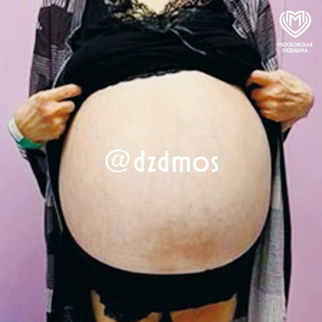 От опухоли размером с огромный арбуз избавили пациентку московские акушеры-гинекологи