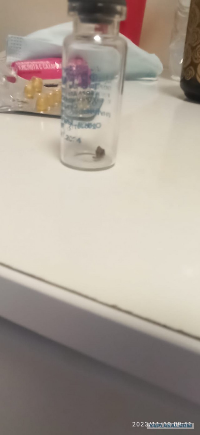 Камни из почек