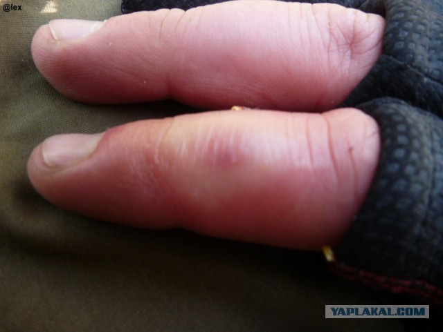 Первая помощь при укусе гадюки