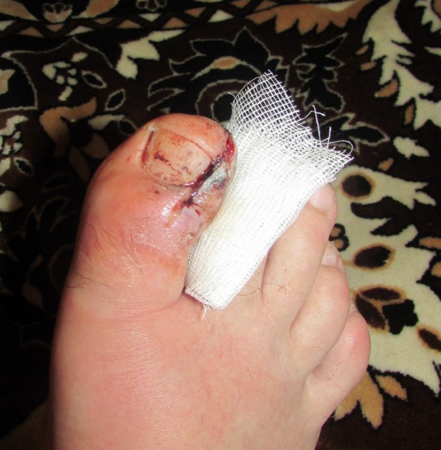 Ноготь большого пальца ноги