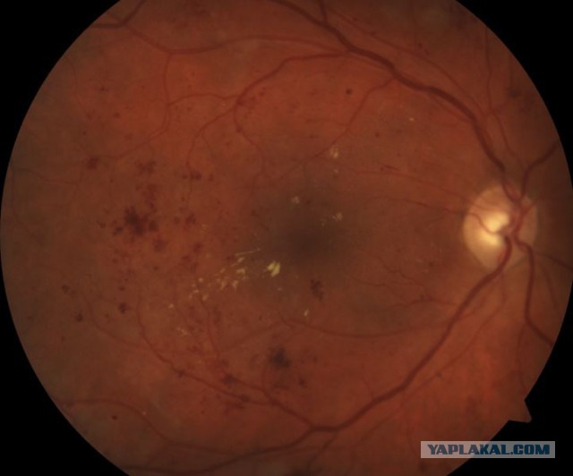 Что ищут офтальмологи на глазном дне?