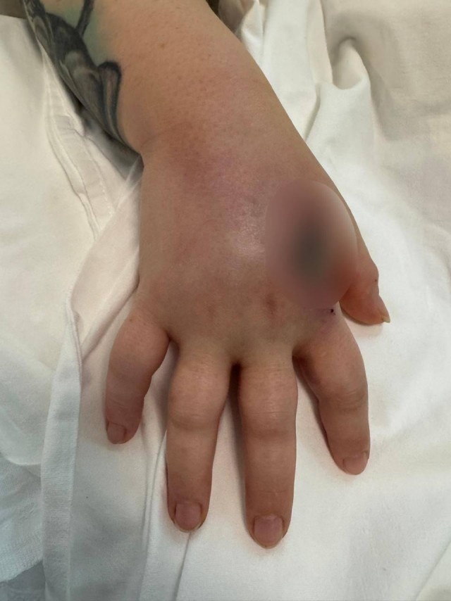 Девушку укусила кобра в парке Подмосковья — она заползла к ней в рюкзак.