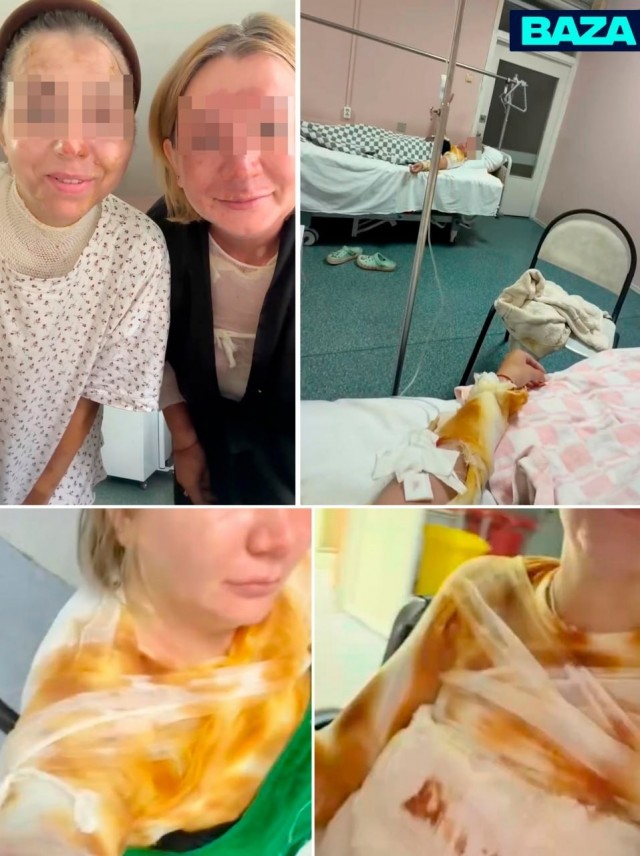 Взорвавшаяся скороварка сожгла почти четверть тела двум девушкам из Ярославской области