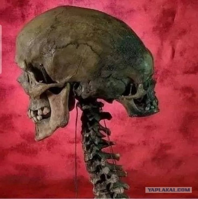 Паразитический краниопаг