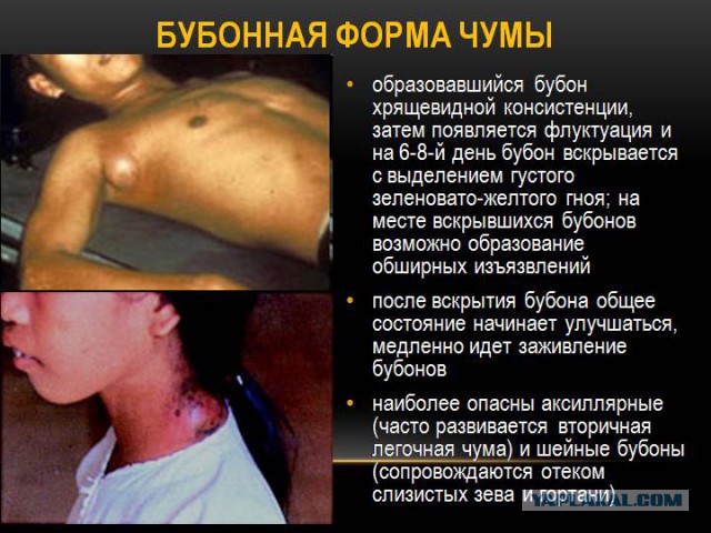 Ребёнка с бубонной чумой госпитализировали на Алтае