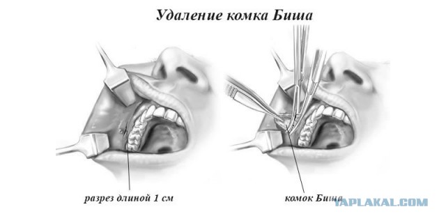 Хирургу, изуродовавшему модель из Сочи, ничего не будет. Его освободили от наказания в связи с истечением сроков давности.