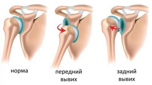 Привычный вывих плеча