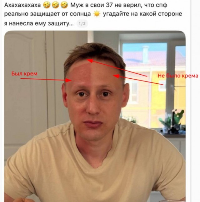 Парень не поверил, что спф реально спасает от солнца