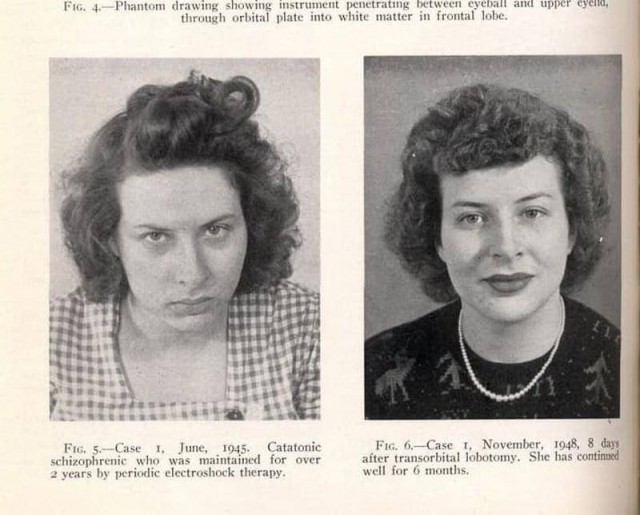 Лоботомия. История потрошения мозгов или Самая постыдная Нобелевская премия