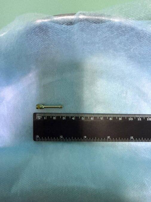 Болт застрял в анусе кемеровчанина после похода к стоматологу