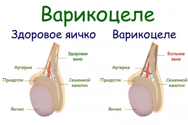 Варикоцеле. Резать или нет?