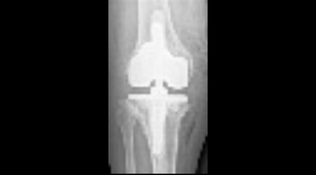 Протезирование коленного сустава