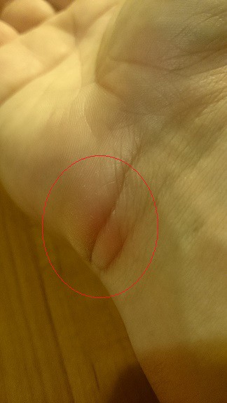 Профессиональная болезнь