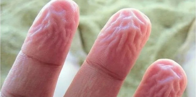 28-летняя жительница Малайзии во время беременности резко постарела за два месяца
