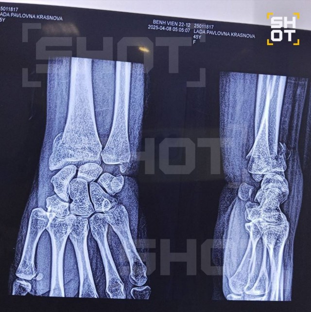 Россиянку жёстко избили во Вьетнаме из-за того, как она общалась с подругой