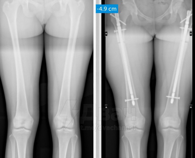 В Стамбуле растёт интерес к операциям по укорочению ног