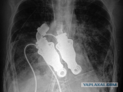 Сердце-турбина или жизнь без пульса