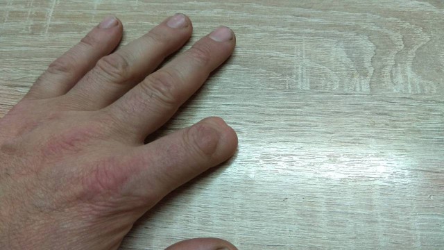 Шрамы на пальце - есть у всех? У меня даже два!