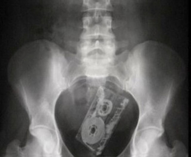 Самые неожиданные вещи, найденные в теле человека