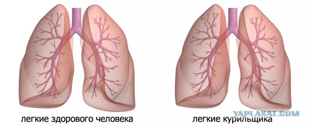 легкие спадают. легкие спадают. плевральная полость пневмоторакс. оболочка покрывающая легкие снаружи называется. пневмоторакс рентген снимки.