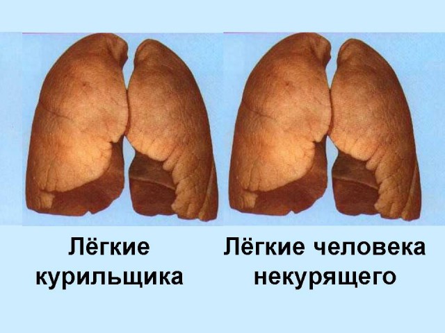 Легкие курильщика