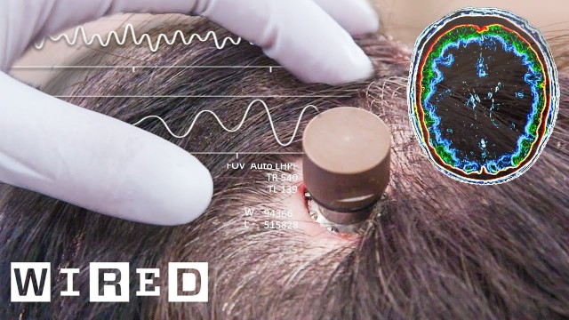 Мечта мозгоправа: СМИ заявляют о «тысячах людей в очереди» на установку имплантатов Neuralink