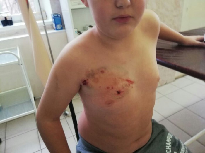 В Магнитогорске алабай напал на школьника