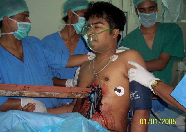 Португальский парень чудом выжил, после того как его проткнуло железякой