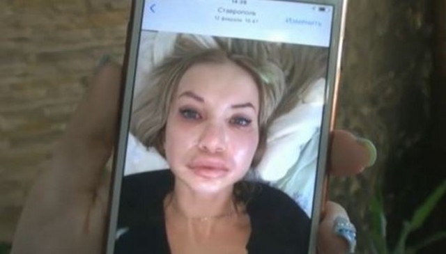 «Раздувало лицо, голову». Девушка попала в реанимацию после уколов у косметолога-самоучки