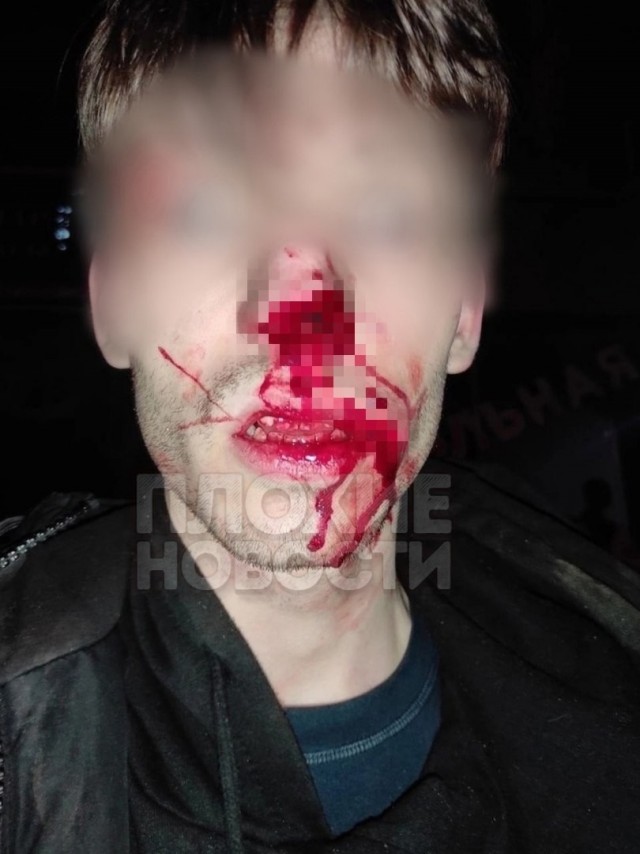 В Новокузнецке дикие мигранты отгрызли ухо и нос двоим парням, которые заступились за подростка