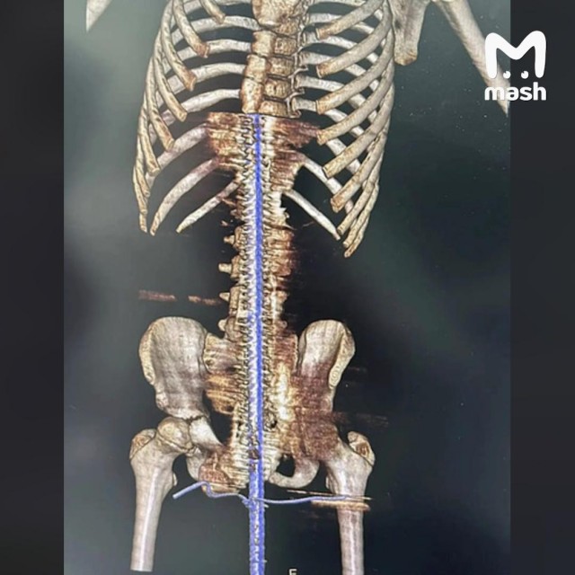 12-летний любитель прыгать по гаражам упал на полуметровый металлический штырь в Кировской области