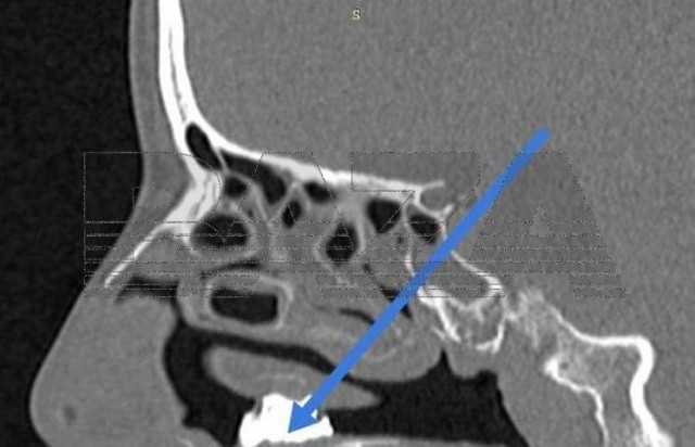 Врачи добыли из носа женщины уголь