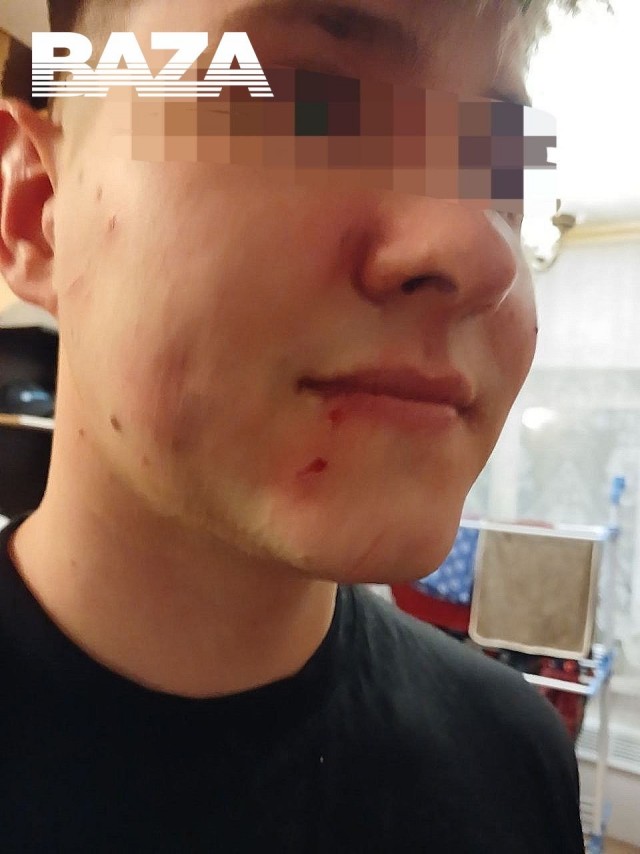 В Московской области подросток едва не лишился глаза после взрыва фейерверка.