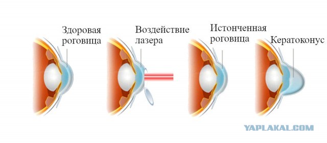Про коррекцию зрения