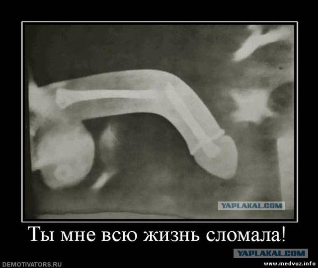 Женская верность лишила мужчин костей в пенисе